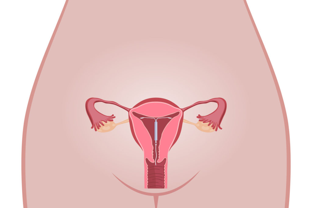 Un nuovo caso Essure? L’Agenzia francese richiama dal mercato tre spirali