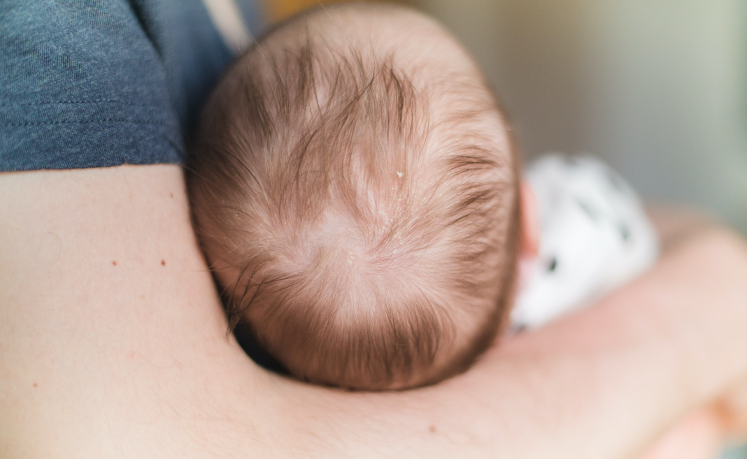 Crosta lattea nei neonati: che cos'è, come riconoscerla ed eliminarla