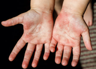 Rosolia in gravidanza: quali sono i rischi per il bambino e quali analisi effettuare rosolia