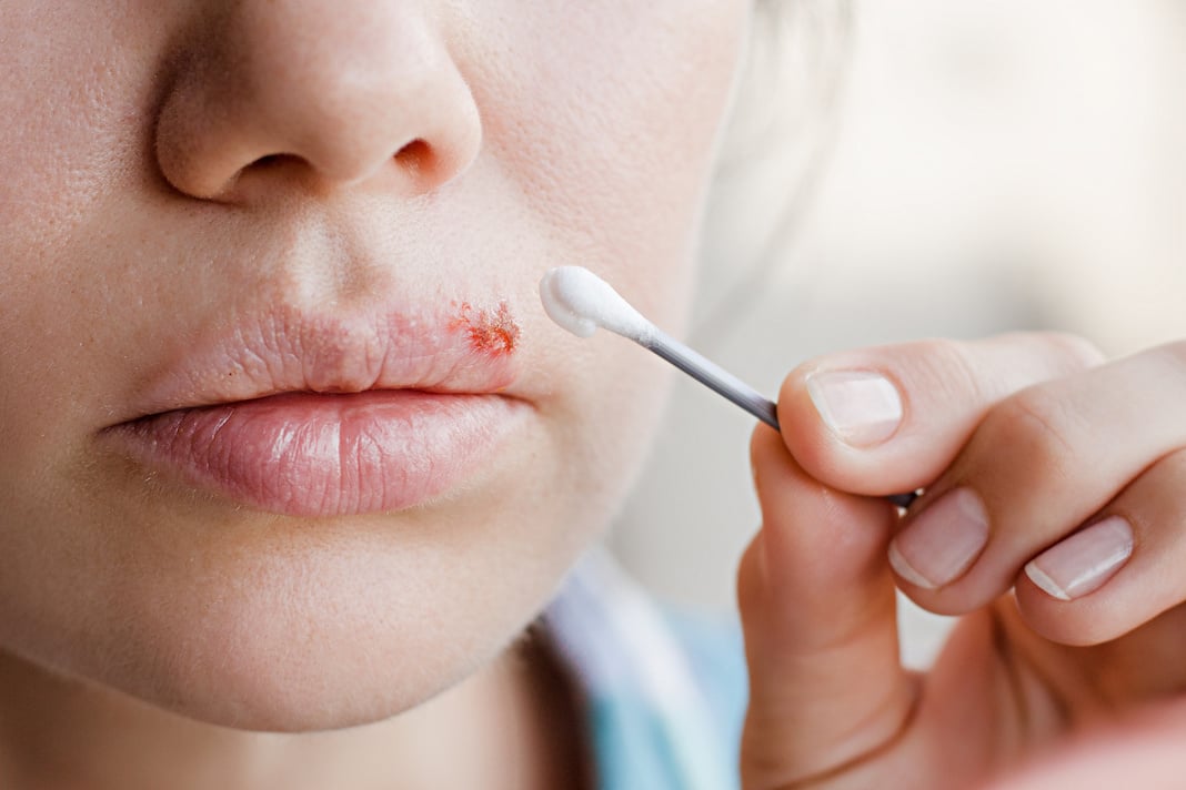 Febbre sulle labbra (herpes labiale): i rimedi più efficaci e