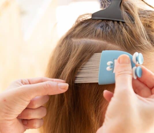 Occhio ai pidocchi (e agli antipidocchi): il test su 7 trattamenti